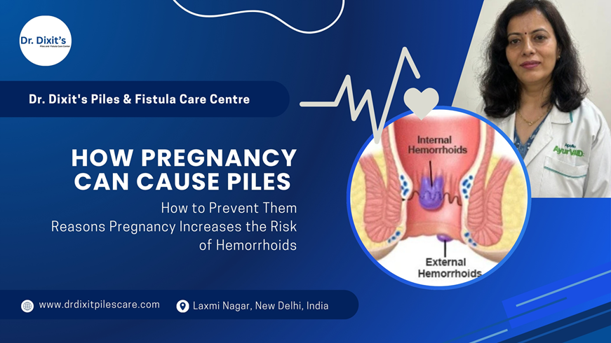 How Pregnancy Can Cause Piles and How to Prevent Them