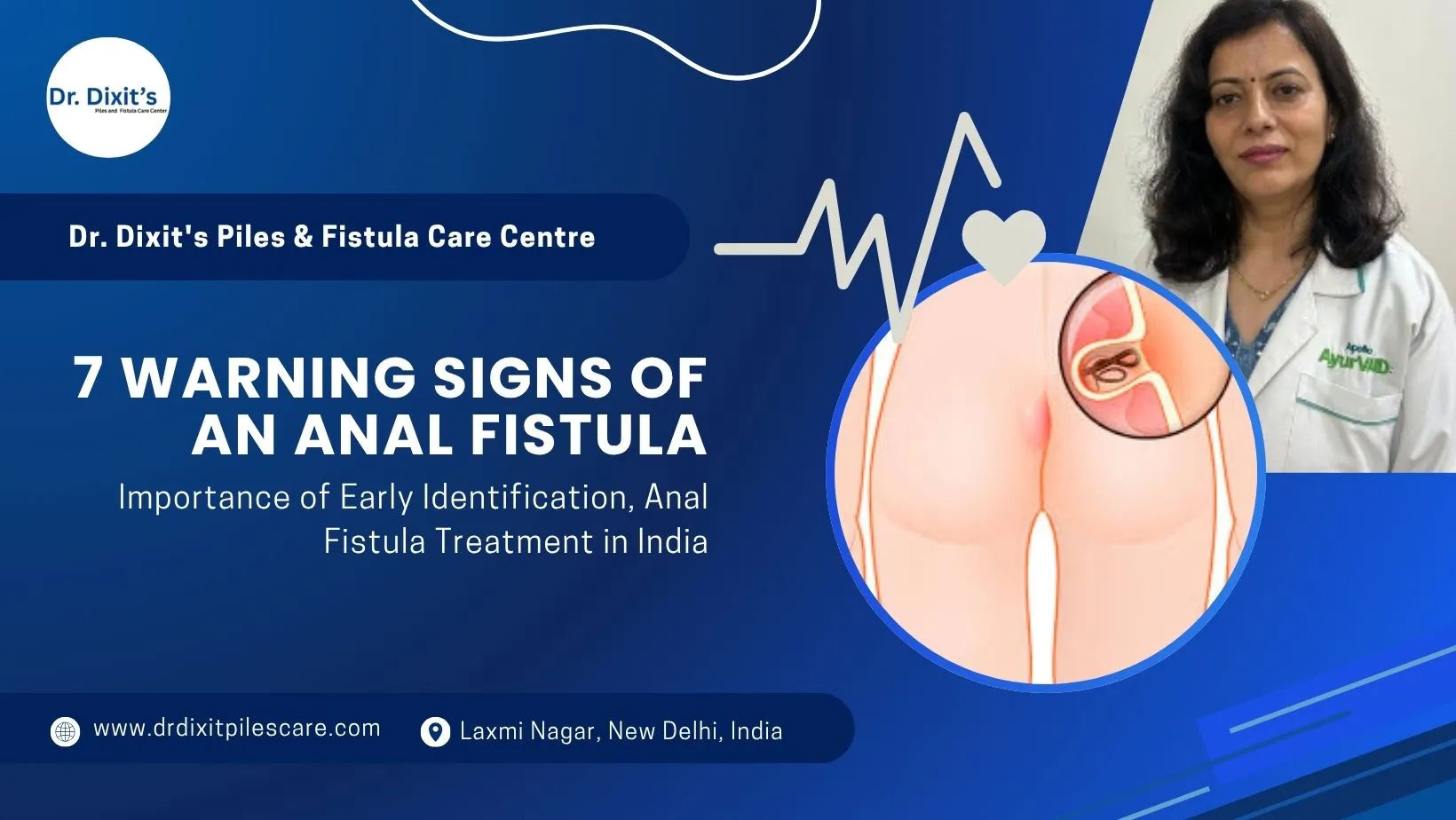 What Are the 7 Warning Signs of an Anal Fistula?