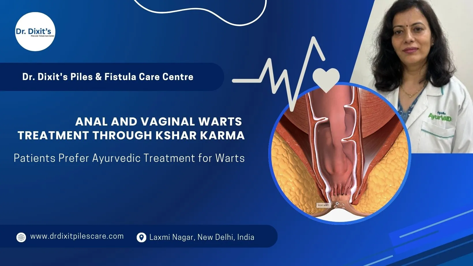 Anal and Vaginal Warts Treatment Through Kshar Karma: A Proven Ayurvedic Approach