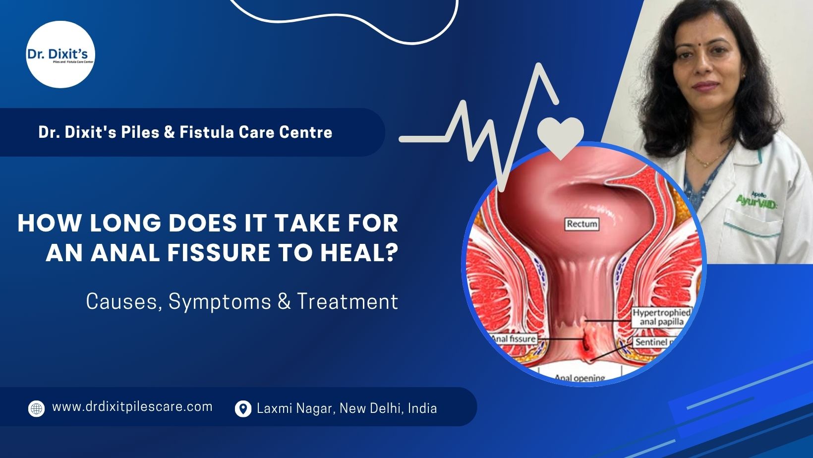 How Long Does It Take for an Anal Fissure to Heal?